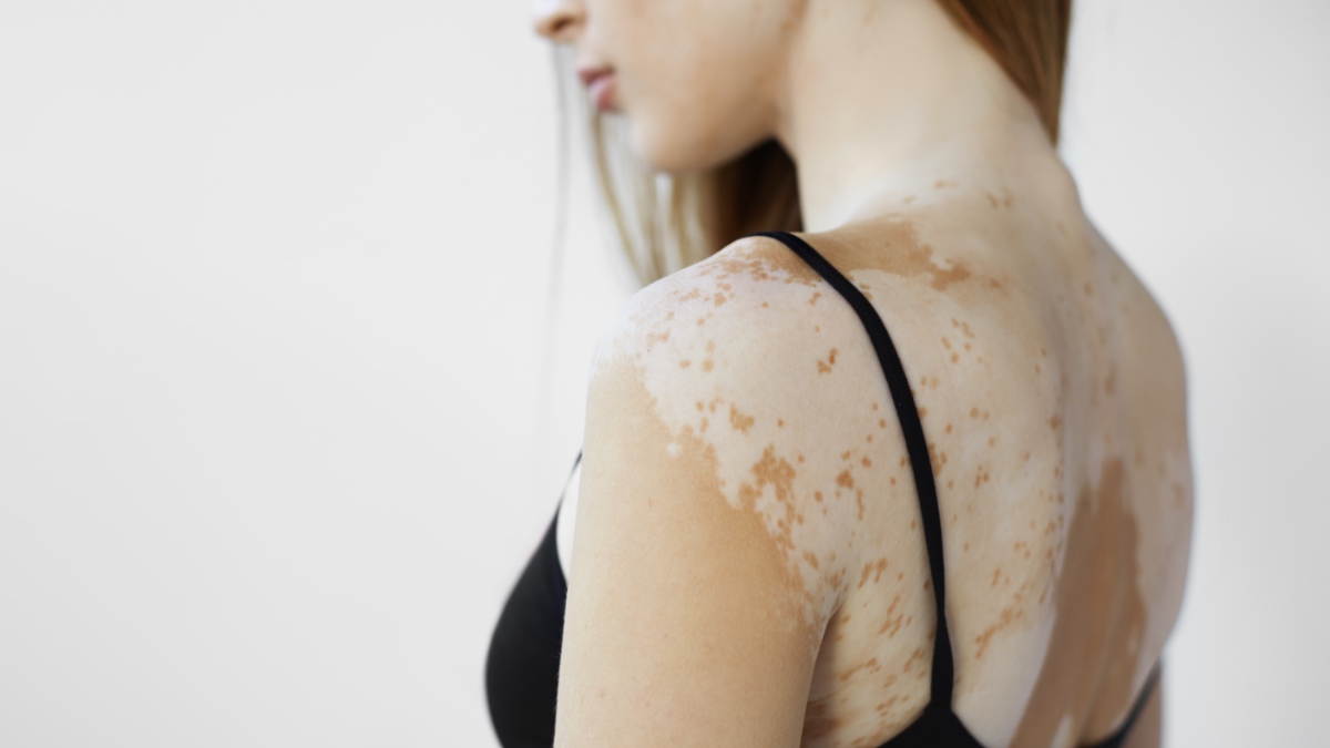 Schlankes weibliches Modell in schwarzem Tank-Top, das an Vitiligo leidet.